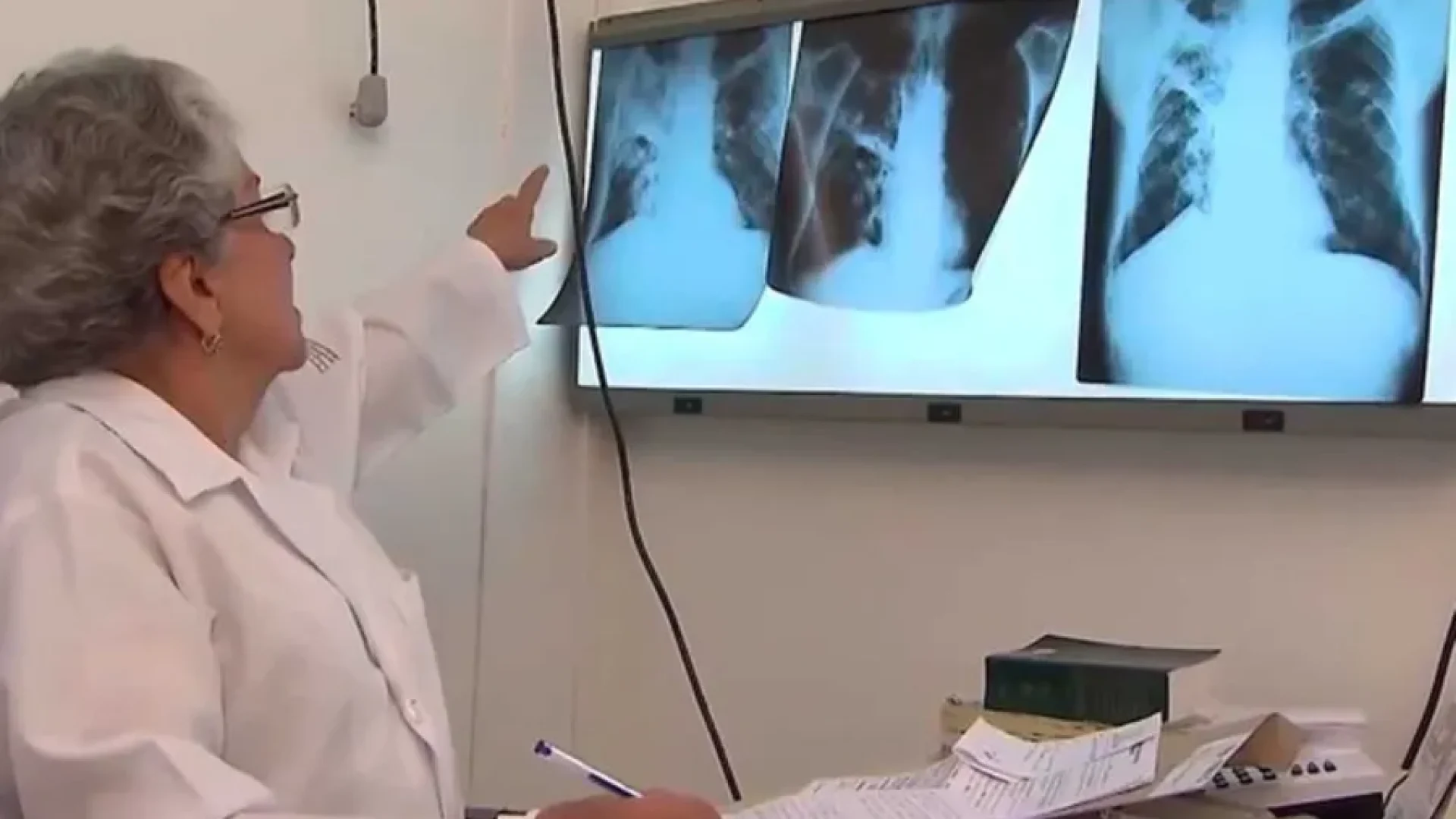 Mortes-por-tuberculose-chegam-a-quase-120-casos-em0021715400202603291225-8